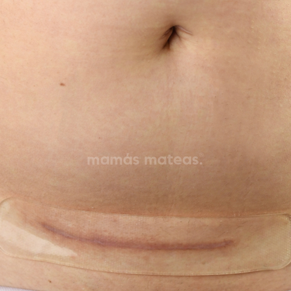 PIUR® Silicone Scar Sheet (Suitable for Cesarean Section)